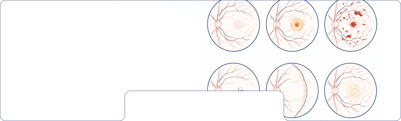 Eye drops being applied during retina care