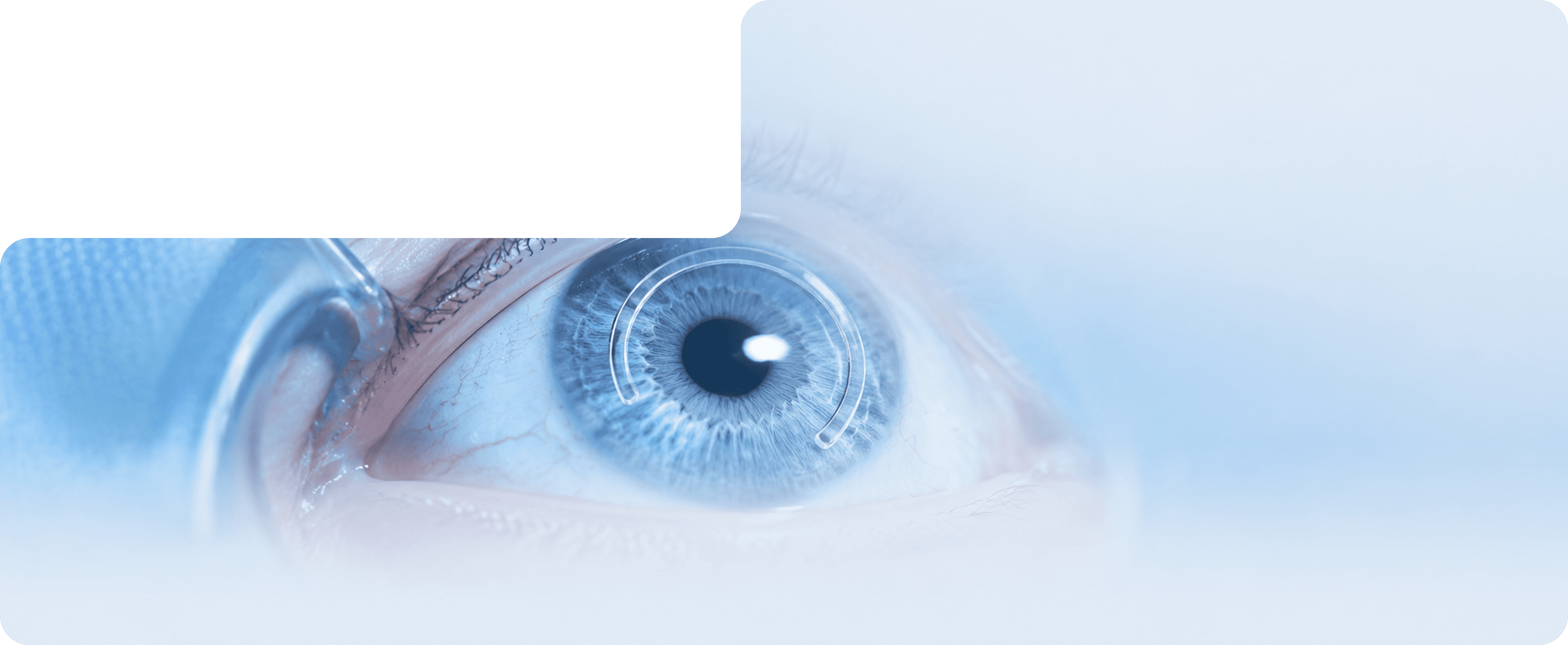 Intracorneal ring segments treatment for keratoconus