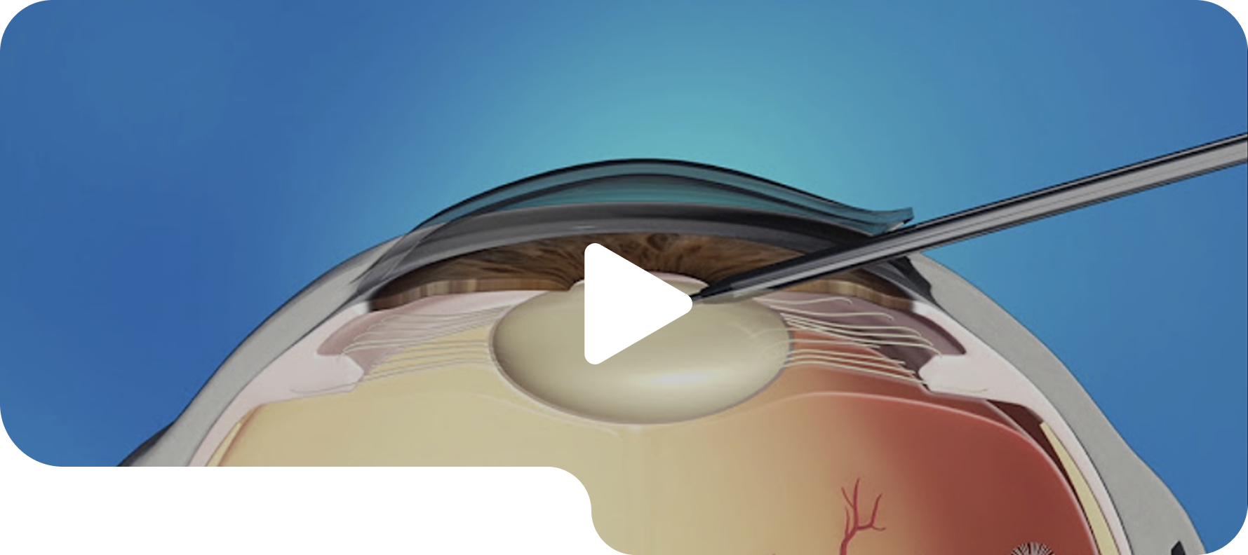 Femto LASIK bladeless procedure