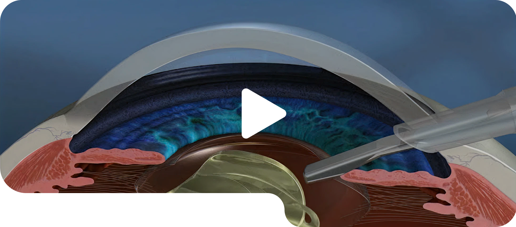 Contoura topography-guided LASIK