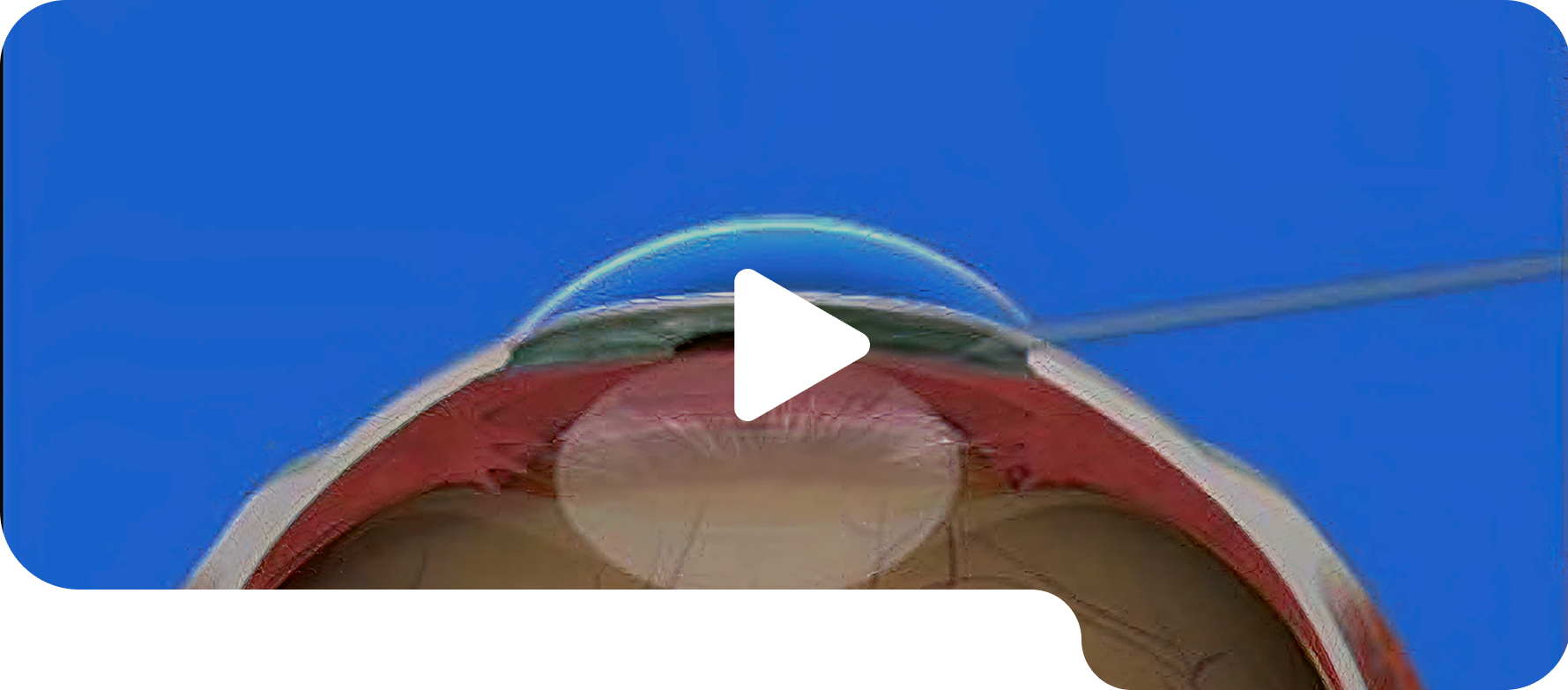 Conventional LASIK procedure